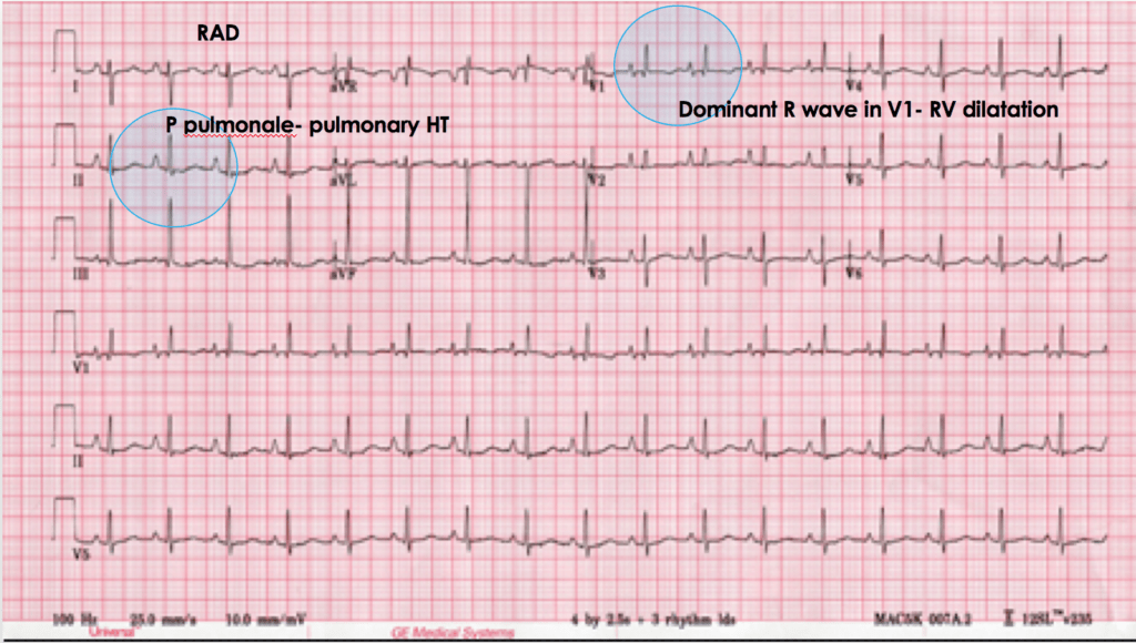 The ECG's of Pulmonary Embolism Resus