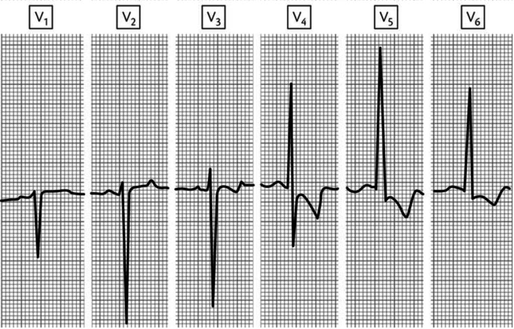 The ECG Of Athletes: Normal Variations You Must Know. - Resus