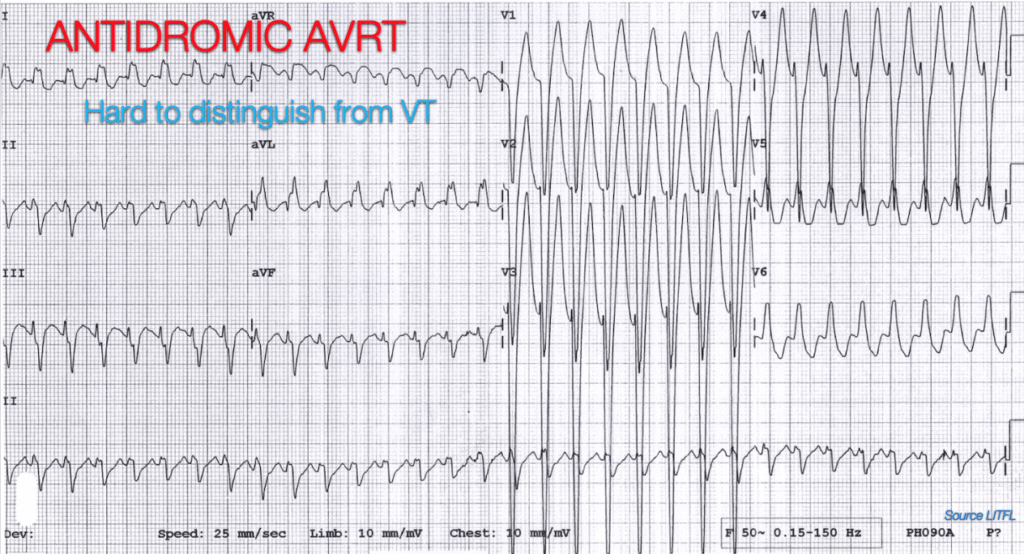 Vt Versus Svt Litfl Medical Blog Ecg Library Basics