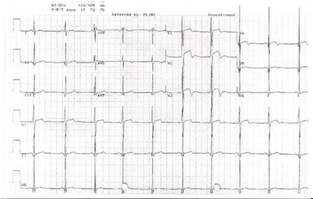 Hypertrophic Cardiomyopathy