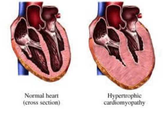 Clinical Pearl- Hypertrophic Cardiomyopathy