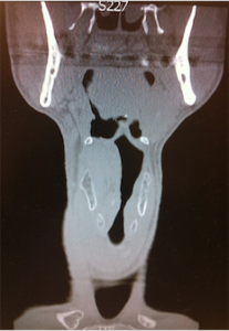 laryngeal fracture 