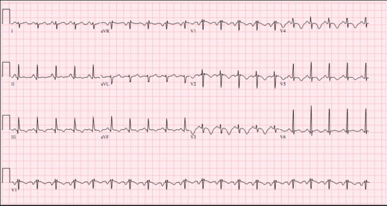 The ECG of Pulmonary Embolism