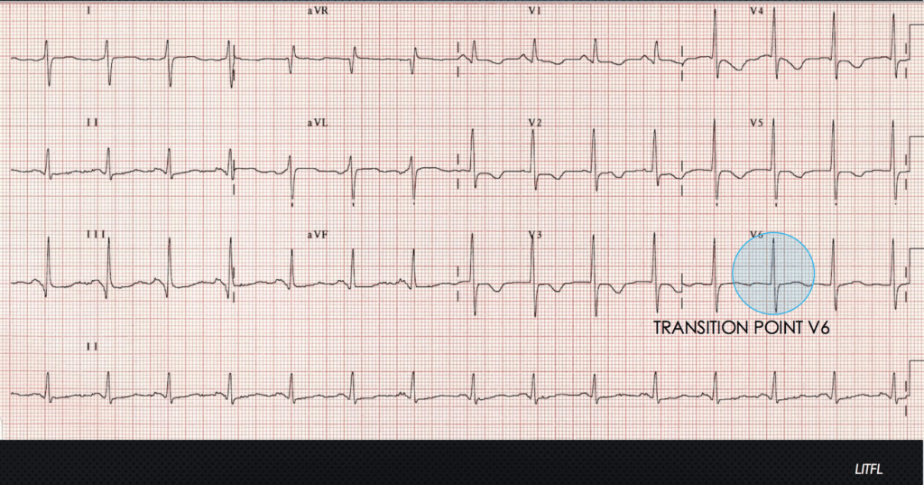 The ECG's of Pulmonary Embolism - Resus