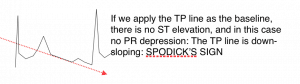 Spodick's Sign and Pericarditis