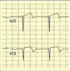 Wellen’s Syndrome