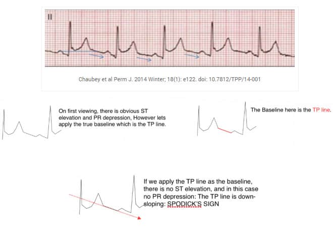 Spodick’s Sign and Pericarditis