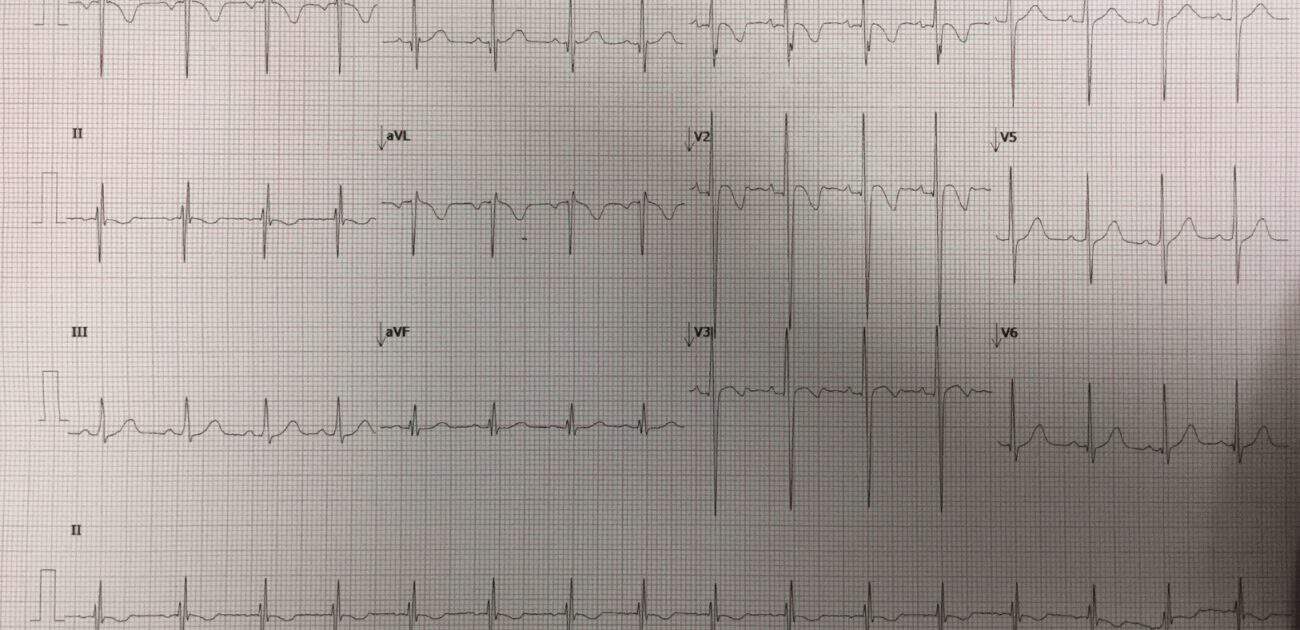 A 9 year old girl with syncope