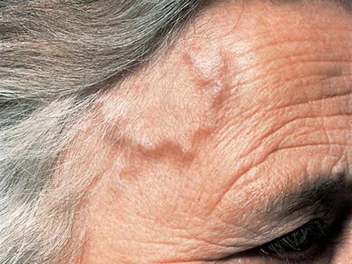 Headache and a near miss case of Temporal Arteritis