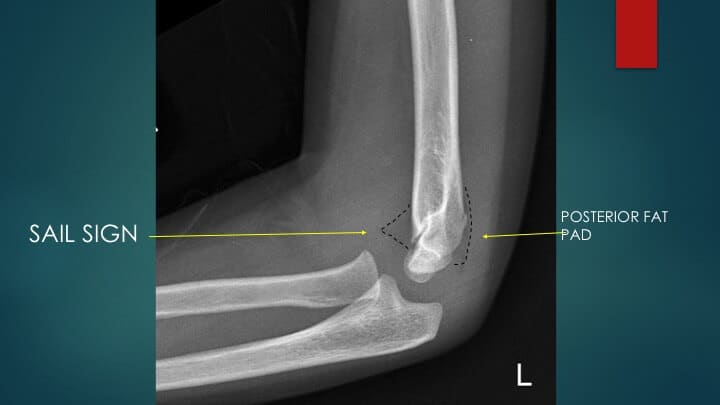 posterior fat pad sign supracondylar fracture