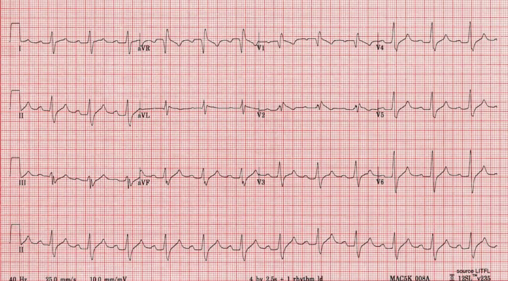 Massive Propranolol Overdose
