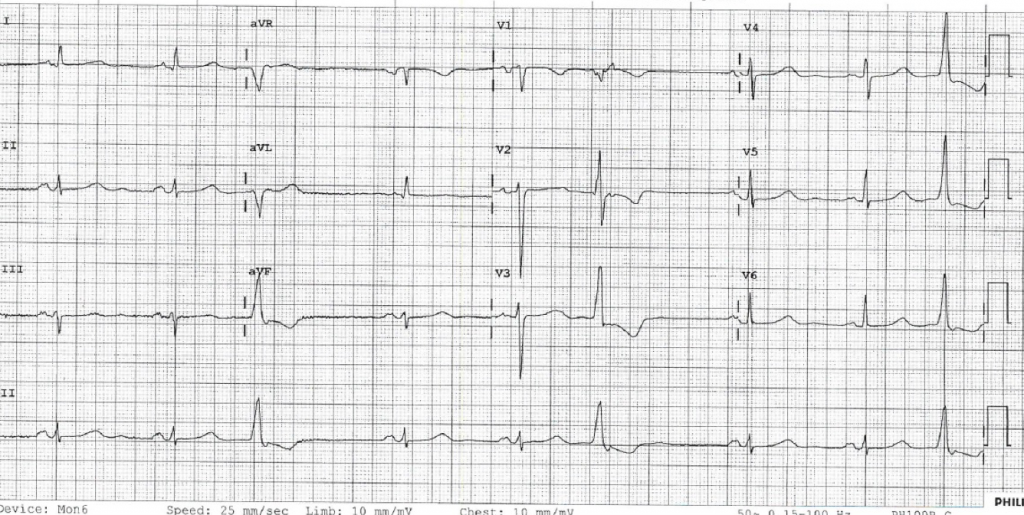 hyperkalaemia