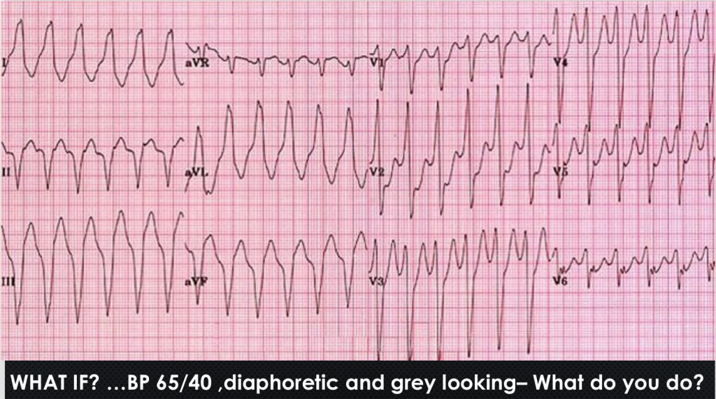 ventricular tachycardia