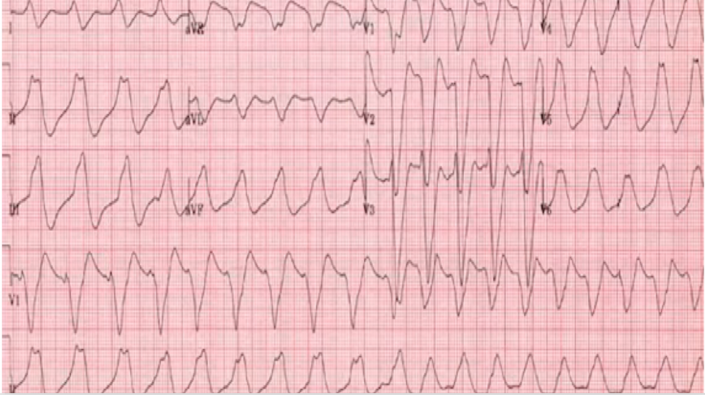 ventricular tachycardia