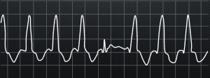 ventricular tachycardia