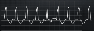 ventricular tachycardia