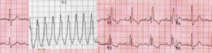 ventricular tachycardia