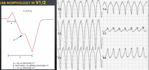 ventricular tachycardia