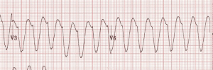 ventricular tachycardia