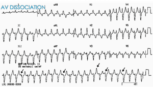 ventricular tachycardia