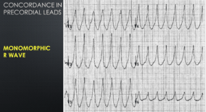 ventricular tachycardia