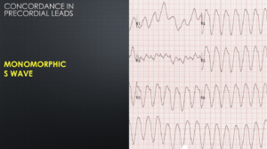 ventricular tachycardia