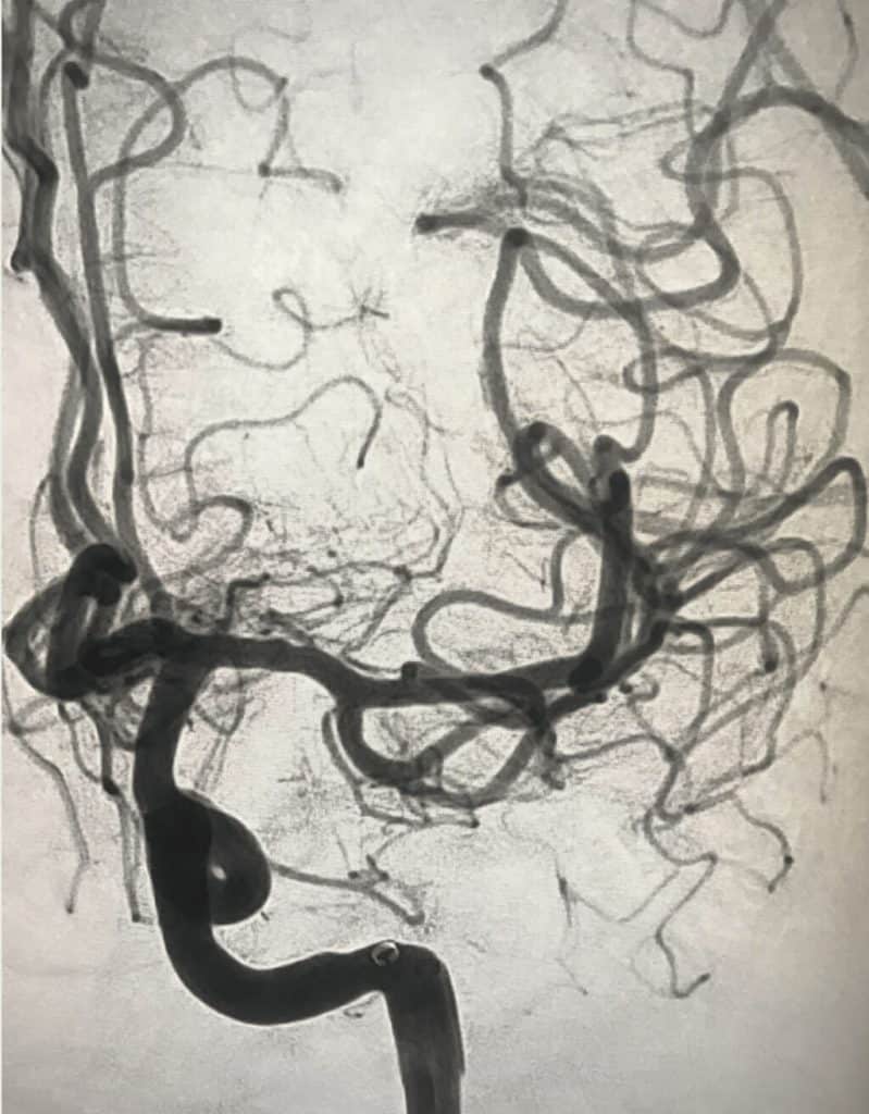 MCA Stroke management