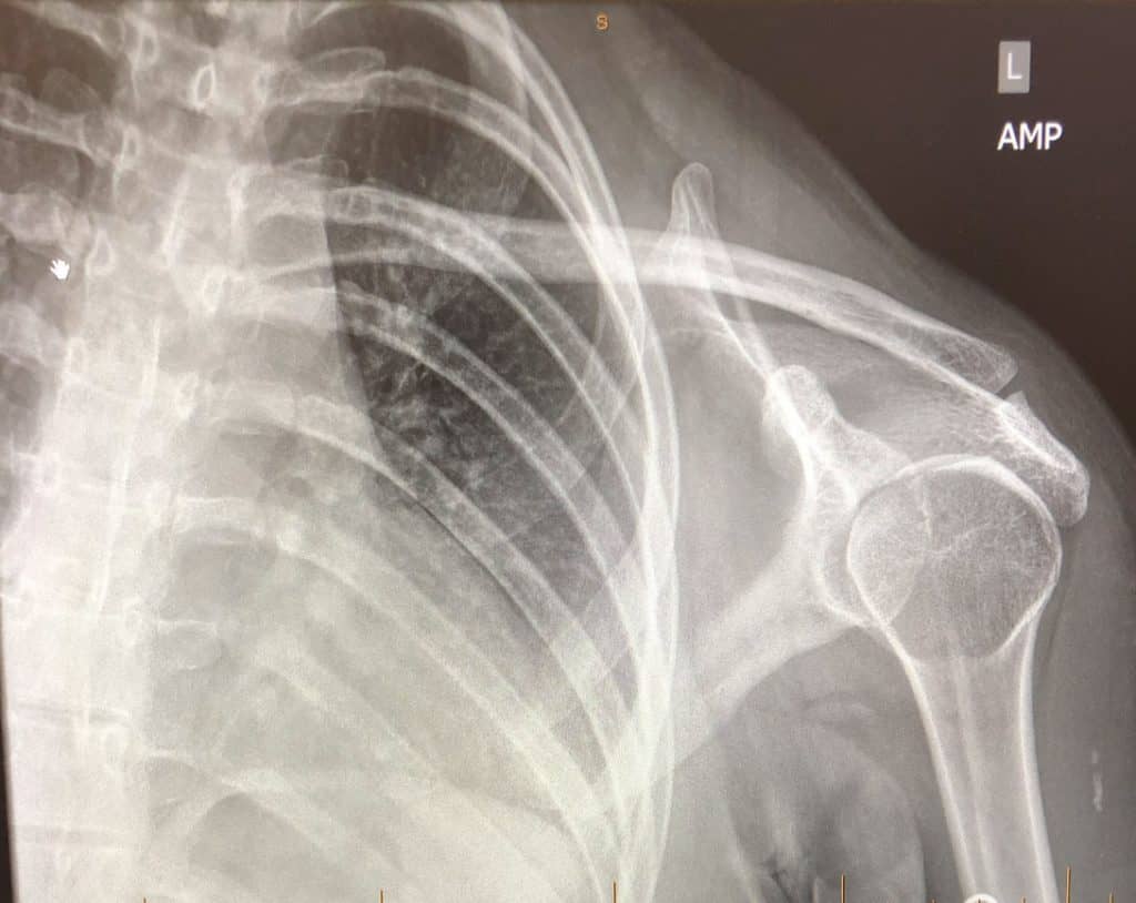 posterior dislocation