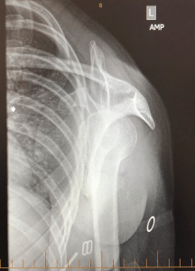 shoulder dislocated
