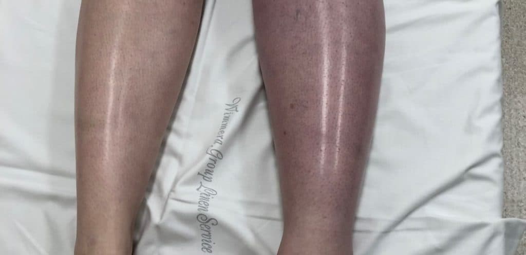 Phlegmasia Cerulean Dolens - Emergency Medicine Education - Resus