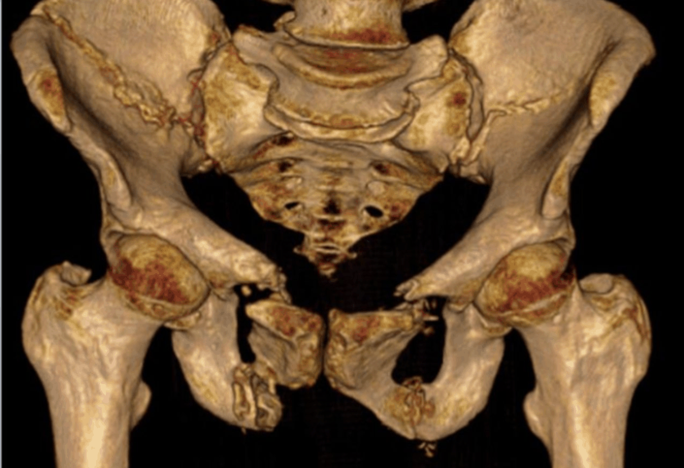 Pelvic fractures