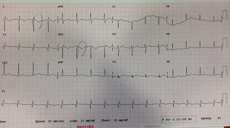 25 year old male with chest pain