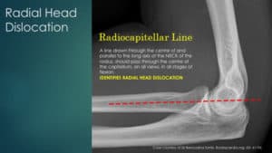 Radiocapitellar line