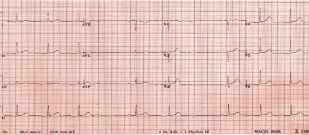 64 year old male with resolved chest pain