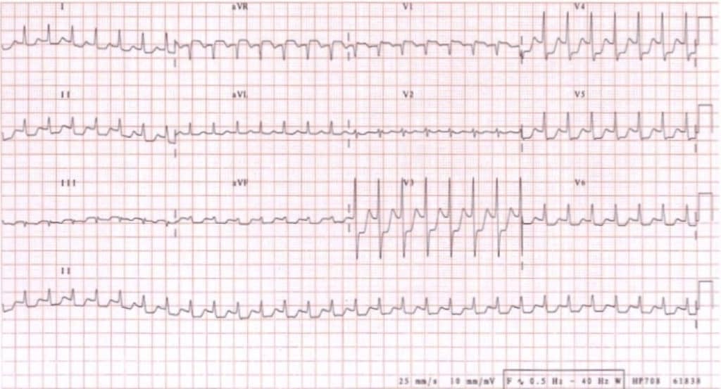 ECG in 20 Seconds Method - Emergency Medicine Education - Resus