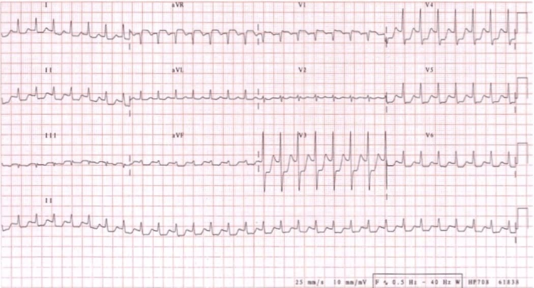 68 year old with palpitations