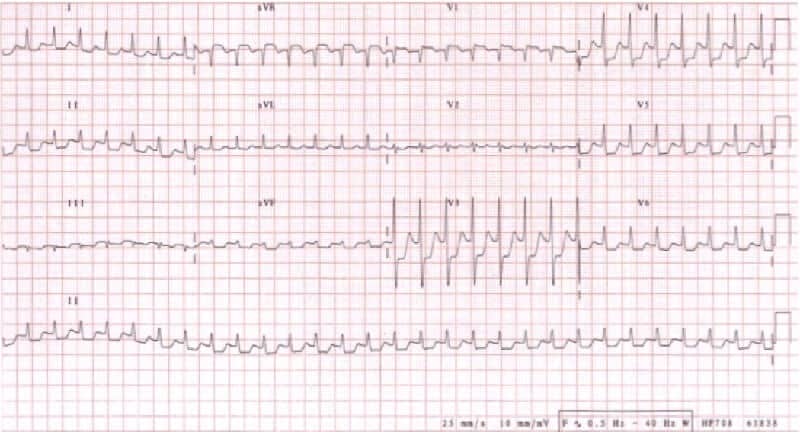 ECG in 20 Seconds Method