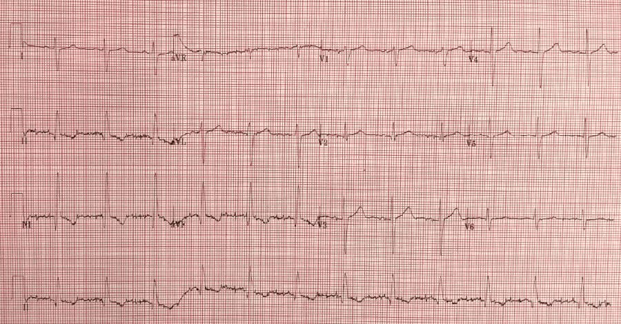 Lithium Toxicity Ecg Changes - Drugs Altering Ecg / Treating lithium ...