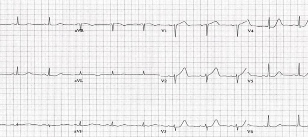 Upright T wave in V1 - Emergency Medicine Education - RESUS