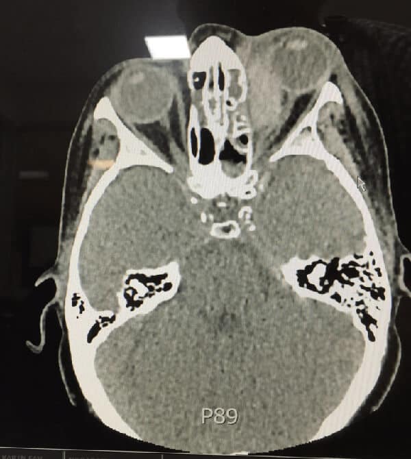 ophthalmological emergency