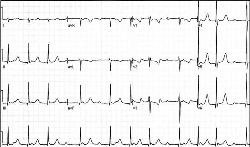 The P Wave ECG Basics MedSchool, 59% OFF