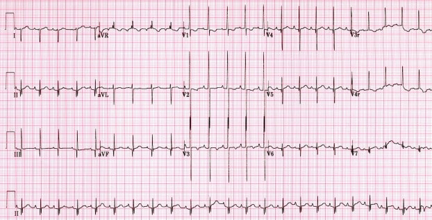 how-to-interpret-the-ecg-ekg-a-systematic-approach-ecg-learning