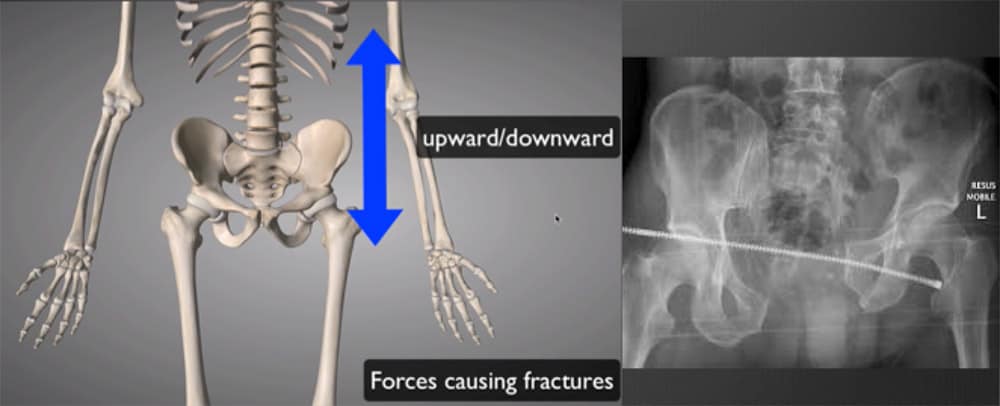 Pelvic fractures