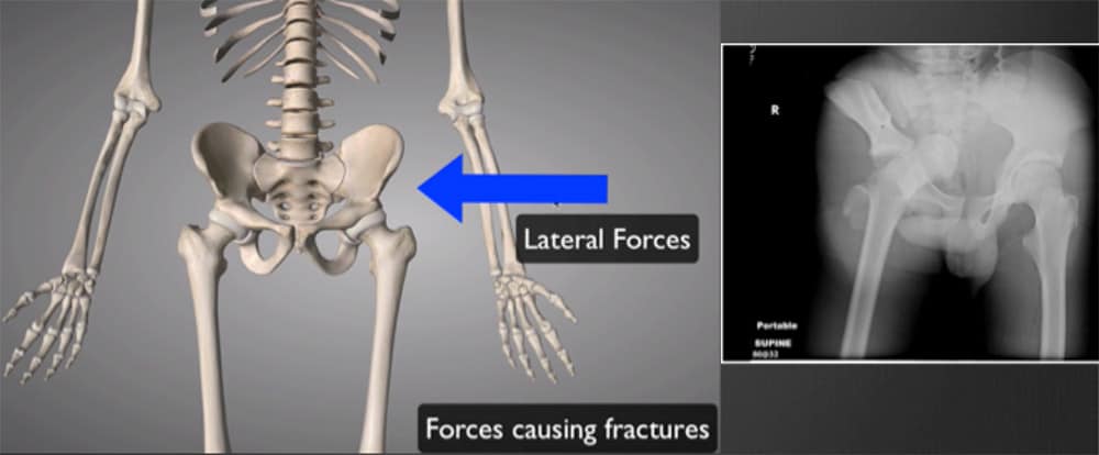 Lateral Forces