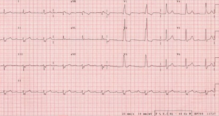 70 year old with syncope