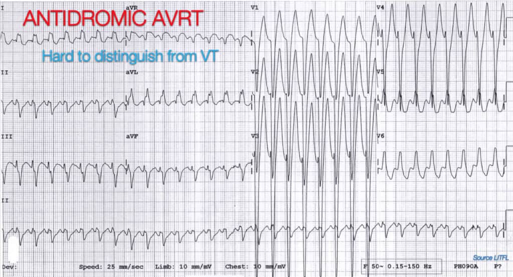 VT vs SVT with Aberrancy | Resus