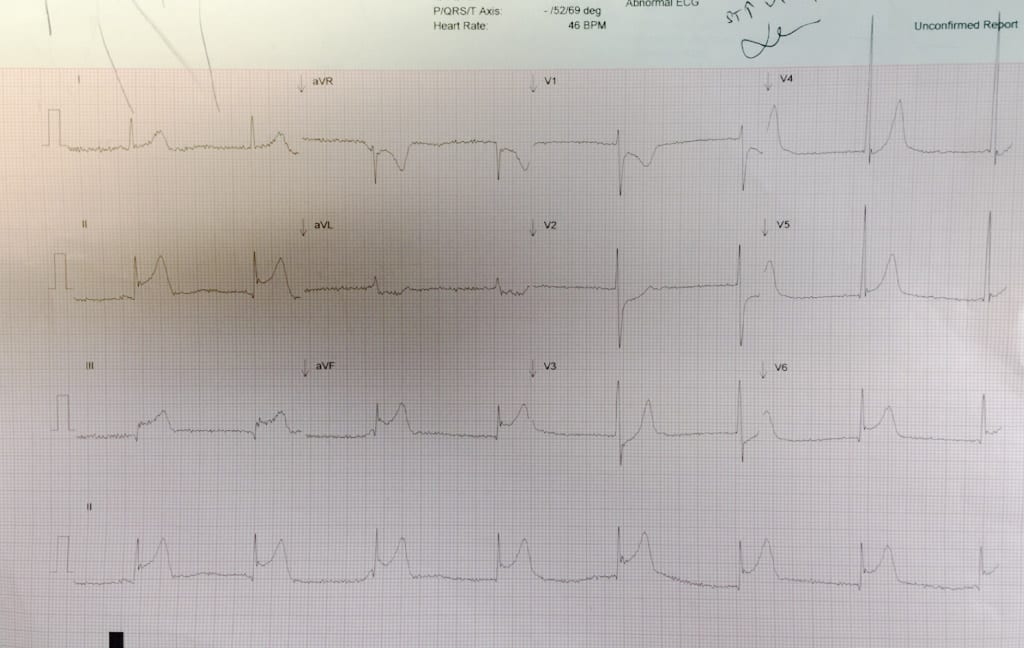 ECG of the Week 6 March 2017