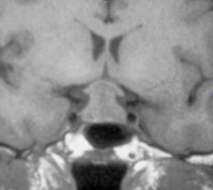 Bilateral Hemianopia in Pregnancy