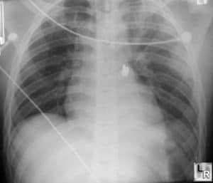 Chest X-ray - Deep Sulcus Sign