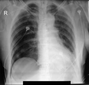 ETCHED MEDIASTINUM